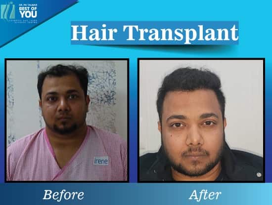 hair transplant result